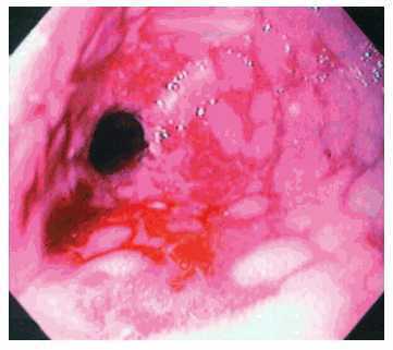 Labels: Acid Reflux Images,