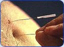 Acupuncture in London