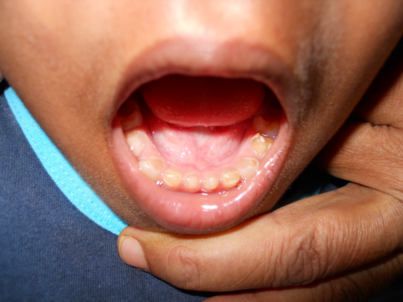 Amelogenesis Imperfecta Pictures