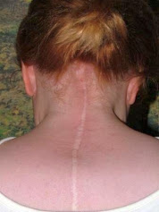 Halo Brace Scar