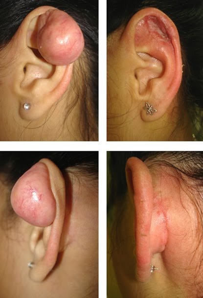 Invas u00e3o Patológica O queé o quelóide? Artesanato Vidro De Esmalte ~ Invas u00e3o Patológica O queé o quelóide?