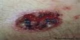 Leishmaniasis