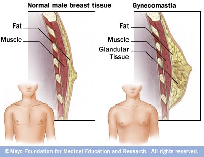 Gynecomastia after steroids