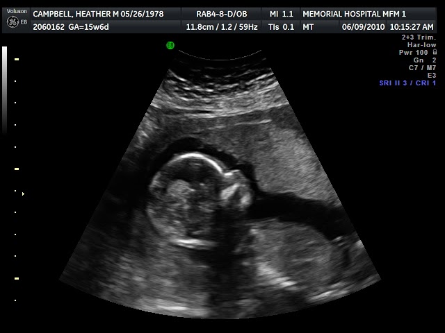 normal amniotic fluid normal amniotic fluid