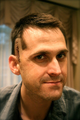 Brain Biopsy Procedure