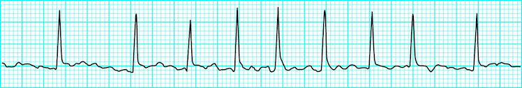 afib rvr