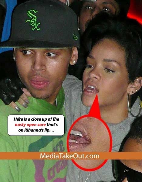 rihanna give chris brown herpes