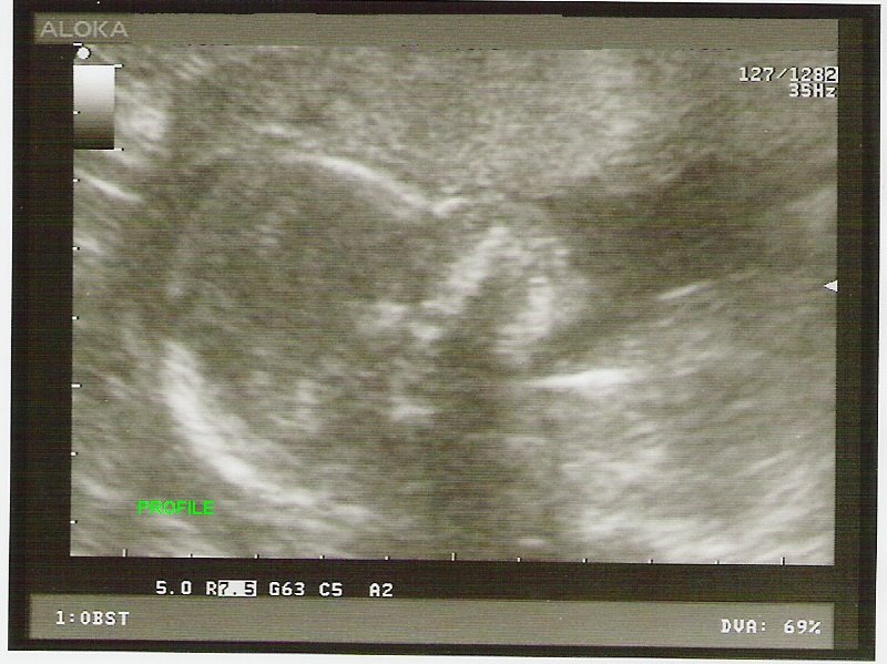 [baby2+19wk+us+2a1.jpg]