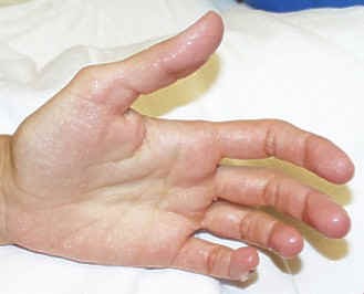 traitement transpiration des mains traitement transpiration des mains