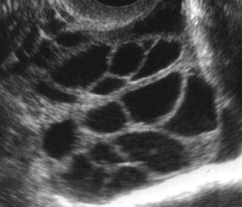 Ovary Ultrasound Pictures