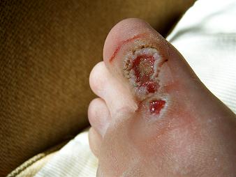 about wart removal and treatment october 2010
