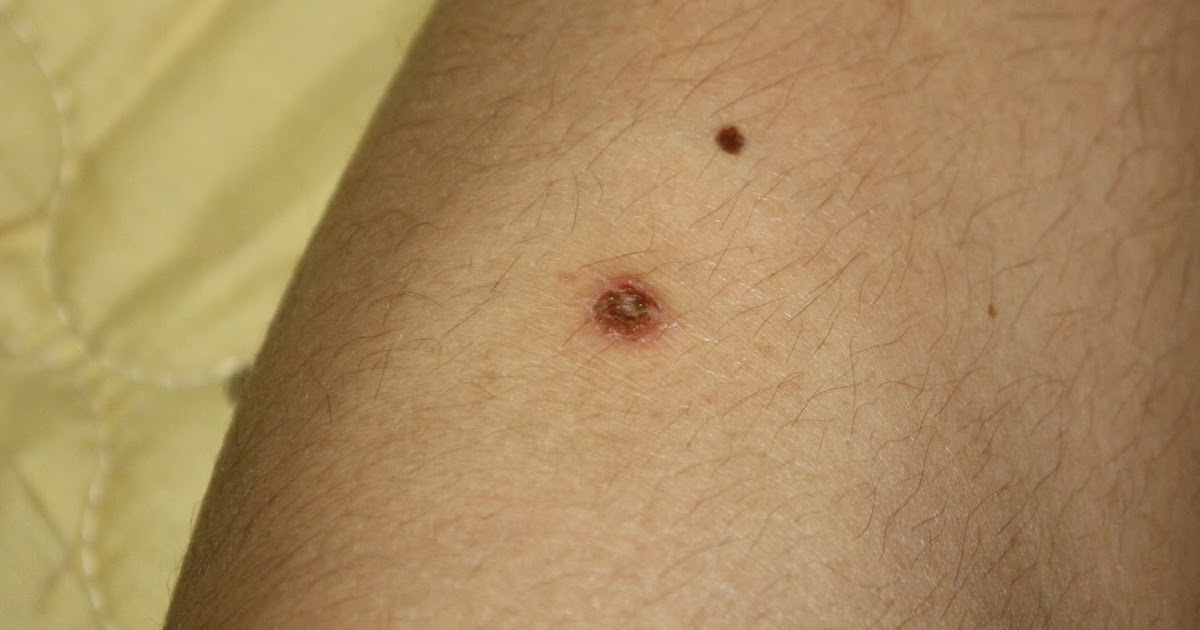 How Do Tick Bites Look Like On Dogs vrogue.co