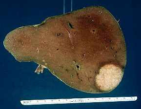 Liver Cancer Pictures