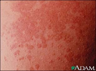 Pharmacy and Medicine: Tinea Versicolor-The Fungal Infection