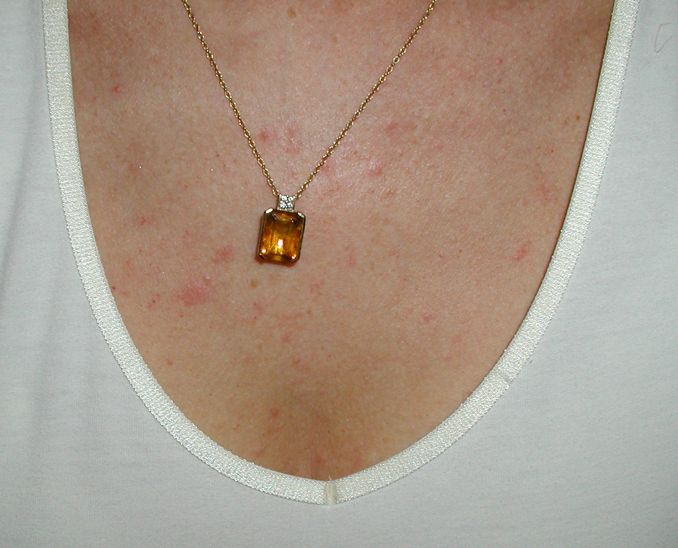 Folliculitis On Chest