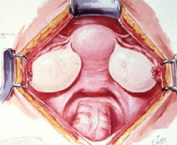 Polycystic Ovary Synd - PCOS