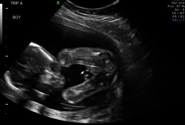 Pregnancy - Our Scientific Journey: Week 20 Repeat Anatomy Scan