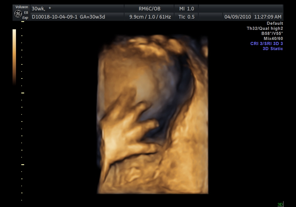 .: 3D Ultrasound
