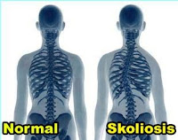 scoliosis+atau+skoliosis.jpg