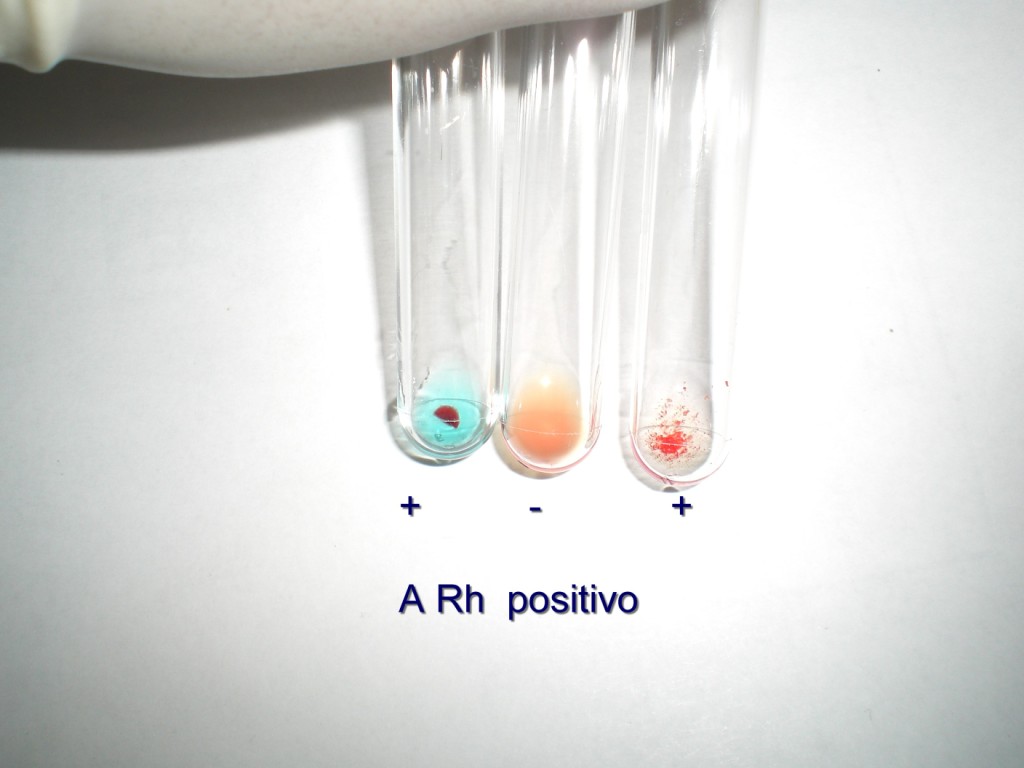 Blood Typing Agglutination