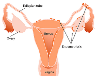 [Endometriosis.png]