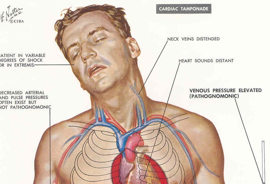 Pedi cardiology CathLab/ICU Cardiac Tamponade/Pericardiocentesis