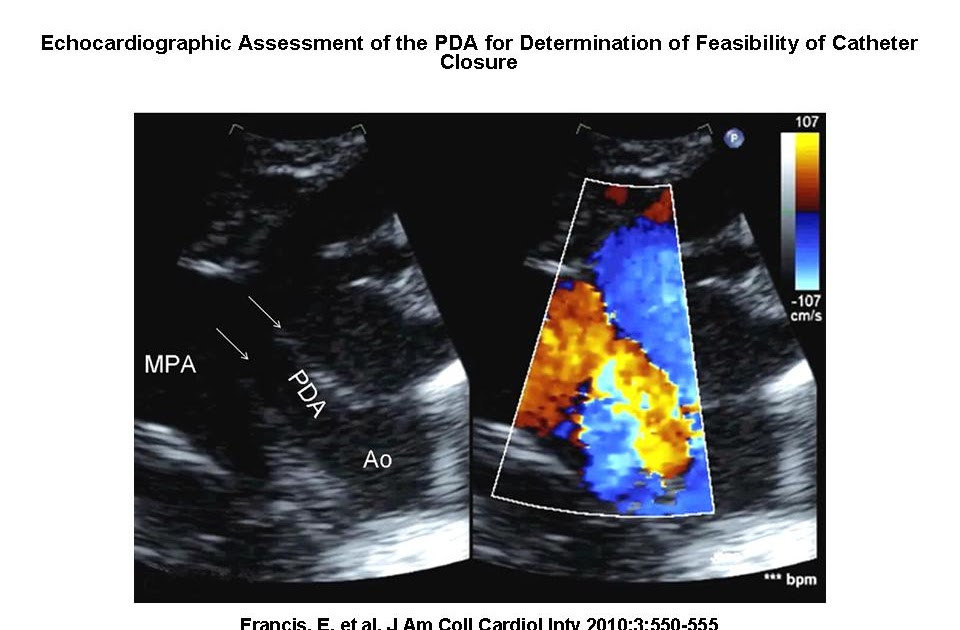 Journal Club Cath PDA coil closure in preterm