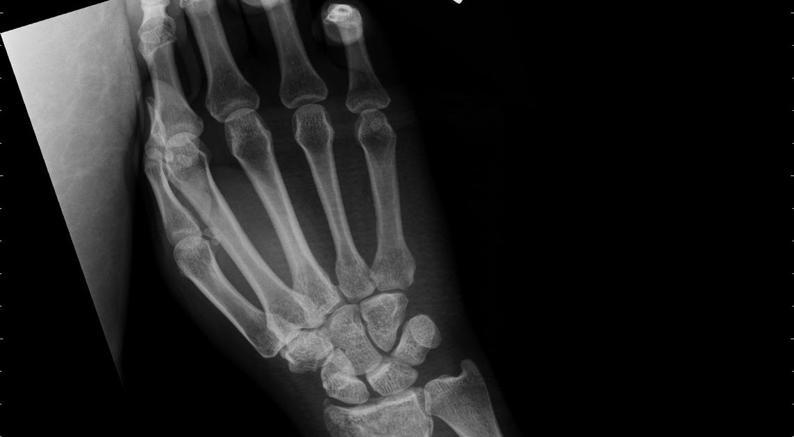 Big Bad: Distal radius fracture with acute scapholunate ...