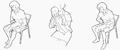 HEIMLICH Compression thoraciques sur un bebe