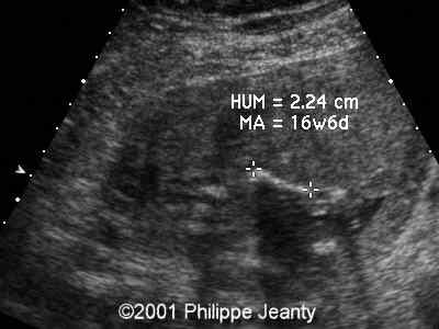 Aneuploidías Trisomía 16