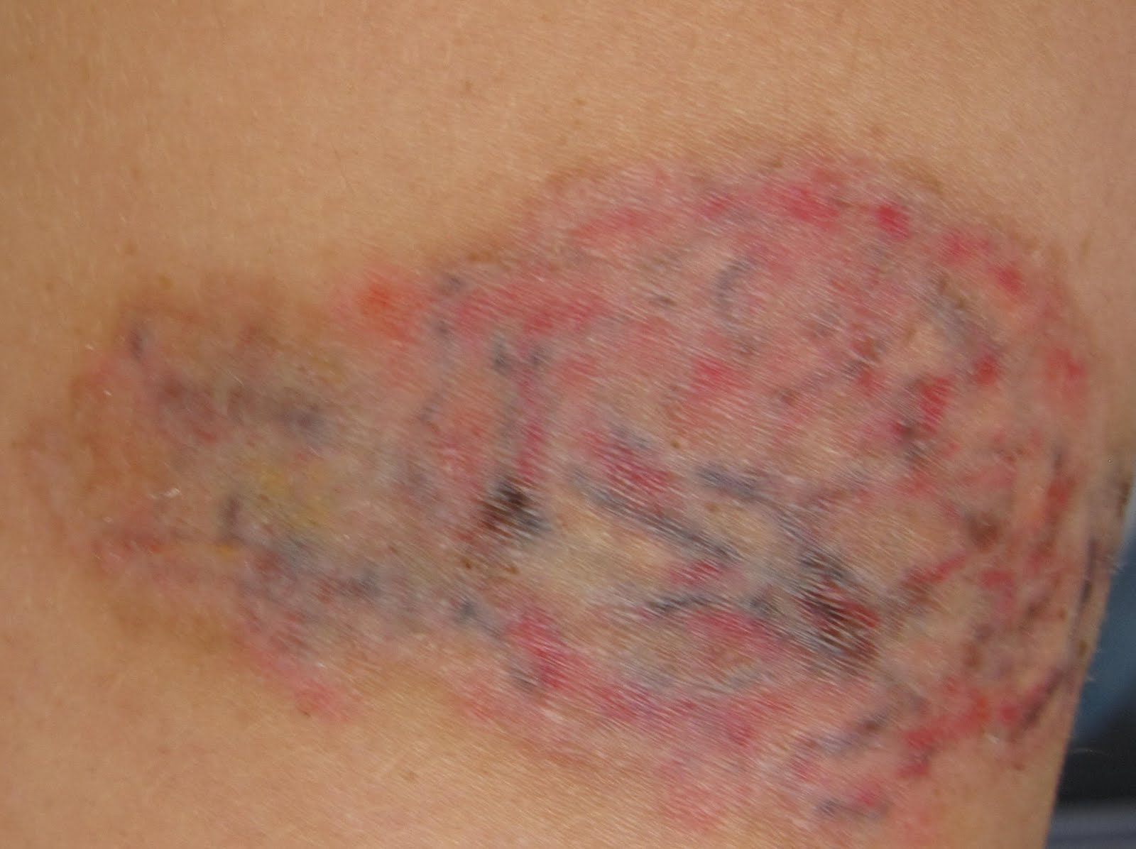 Chronicles of a Tattoo Removal: Bye, Bye Burn...