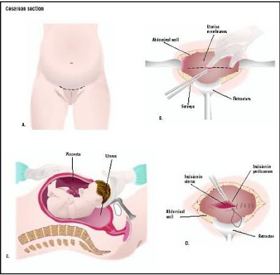 Baby Delivery Process