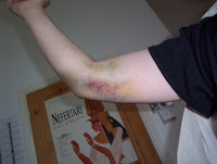 my arm after the accident