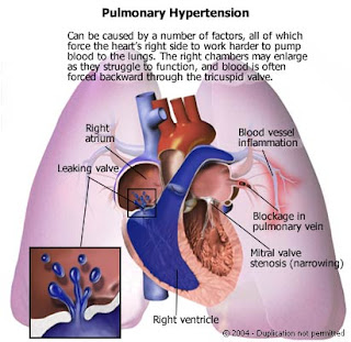 pulmonary hypertension pulmonal hipertensi persistent lungs quizlet cardiac respiratory chronic cause phimaimedicine asthma fibrosis ncp stenosis mitral   