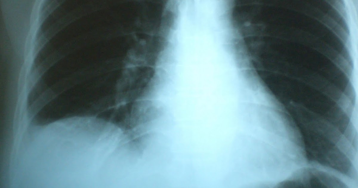 Phimaimedicine 35. Platelike atelectasis