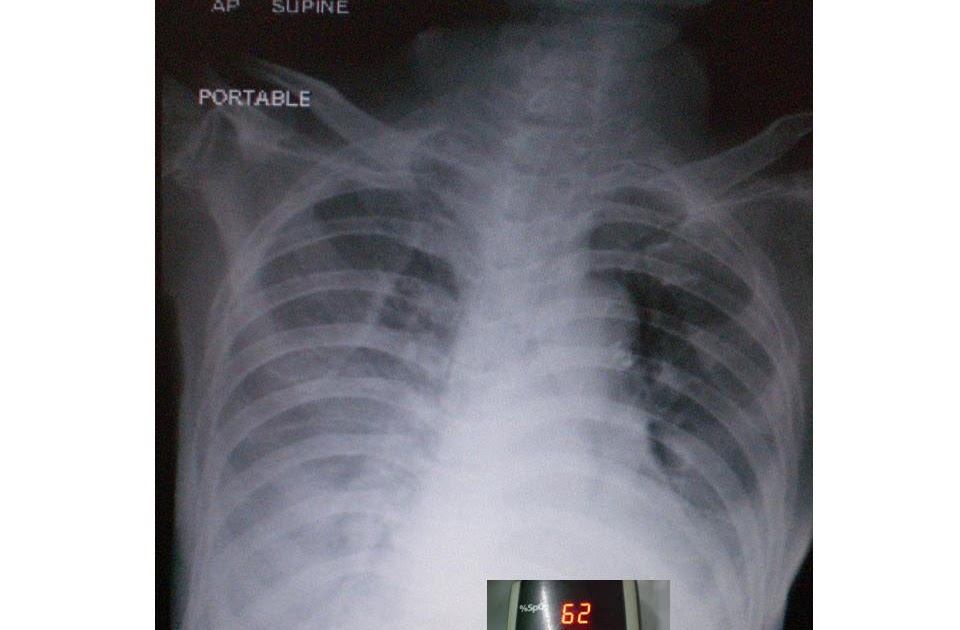 Phimaimedicine 91. Pleural effusion in supine position of CXR