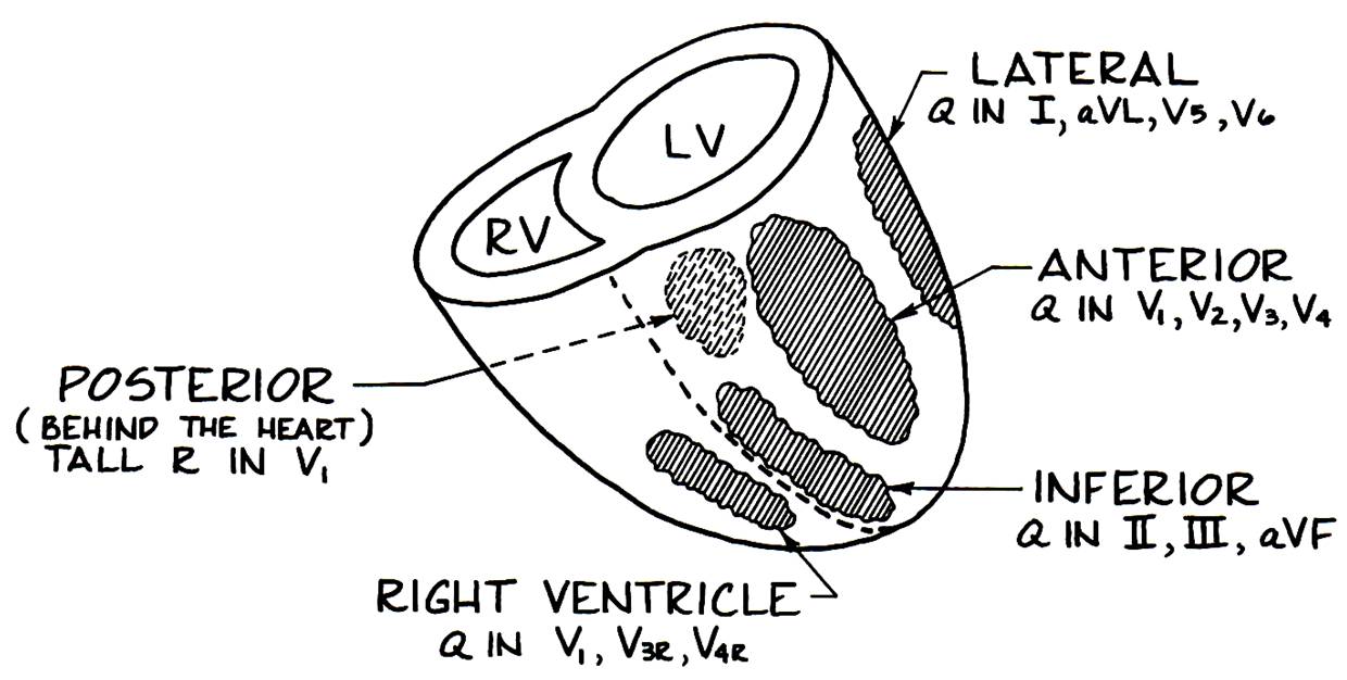 Phimaimedicine 715. Inferior wall myocardial infarction with complete atrioventricular block