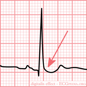 ECG changes typical for digoxin intoxication are