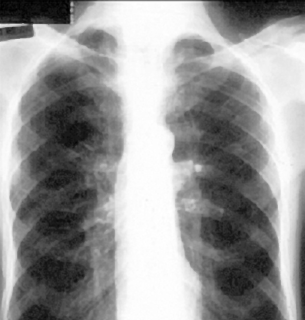 Phimaimedicine 941. Chest Xrays of chronic obstructive pulmonary