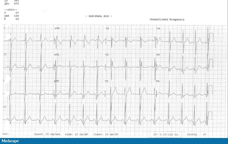 Medscape-EKG.jpg