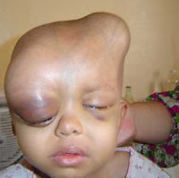 The effects of depleted uranium, used in Iraq