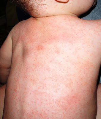 Measles Vaccine Rash