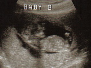 Here is Baby B!