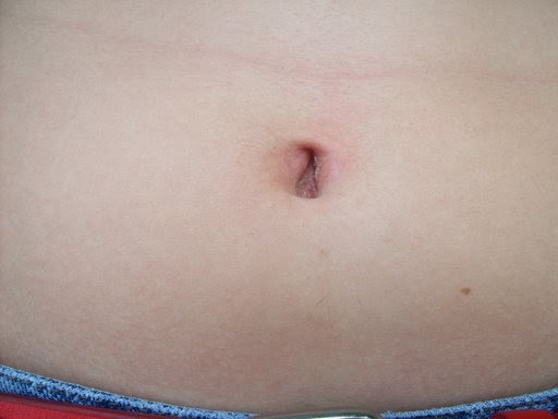 Dunbar Memorial Garden: A series of unfortunate chigger bites