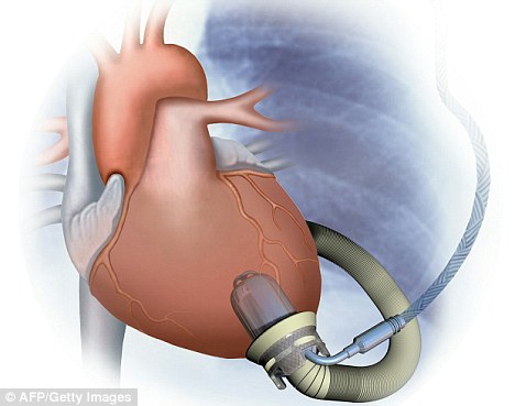 Italian Boy's artificial heart after implantation