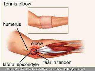Steroid injection arm pain