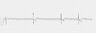 saw tooth pattern ecg saw tooth pattern ecg