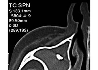 Image from Aspergillus mycetoma of the Maxillary Sinus Secondary to Overfilling of a Root Canal by Luciano Giardino, MD, DDS, Francesco Pontieri, MD, Enrico Savoldi, MD, DDS, and Federico Tallarigo, MD