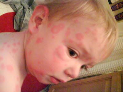 Fifth Disease, A Mystery!