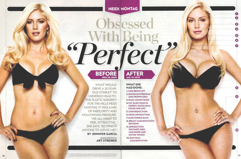 heidi montag surgery before and after. Heidi+hills+efore+after